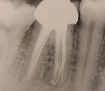サーマフィルで３次元的に根管充填された症例