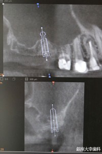 ４サイナスリフト後にインプラントを埋入したレントゲン→2